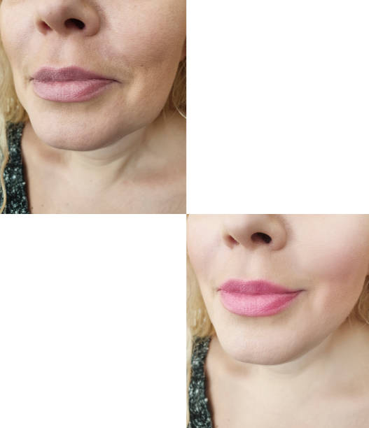 istock woman face wrinkles before and after procedures 1152051893