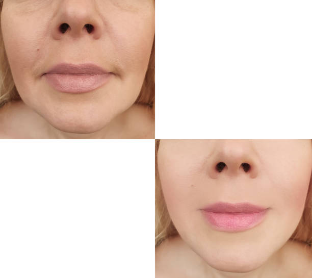 istock woman face wrinkles before and after procedures 1152057177