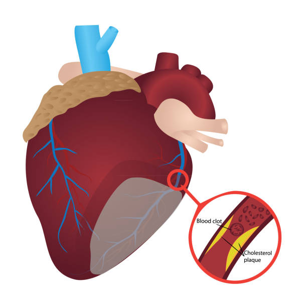 płytka cholesterolu skrzepu krwi w tętnicy obrazowa wektorowa zawału serca - human artery cholesterol atherosclerosis human heart stock illustrations