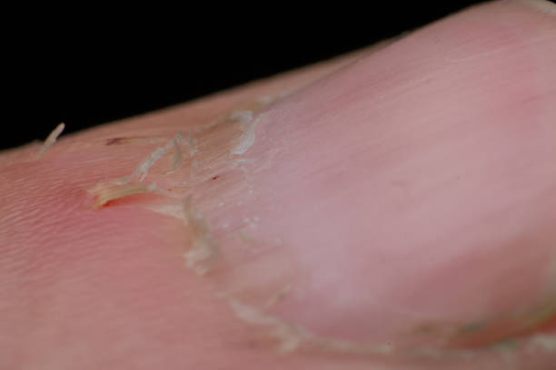 istock chapped skin around the nail close-up macro 1152215244