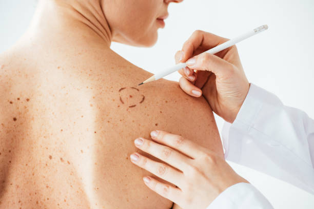 schnittstellung des dermatologen, der markierungen auf der haut der nackten frau mit melanom auf weiß isoliert - dermatologie stock-fotos und bilder