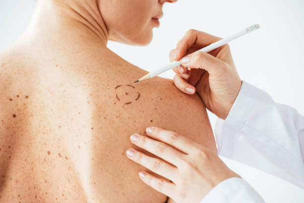 przycięty widok dermatologa stosującego ślady na skórze nagiej kobiety z czerniakiem wyizolowanym na białym - melanoma mole human skin dermatology zdjęcia i obrazy z banku zdjęć