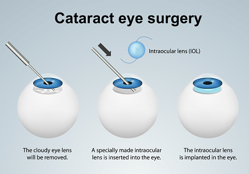 cataract eye surgery process medical vector illustration isolated on grey background