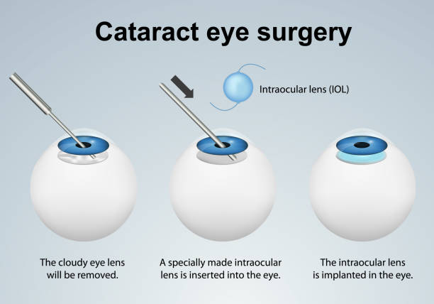 410+ Cataract Surgery Illustrations, Royalty-Free Vector Graphics & Clip Art - iStock | Laser cataract Cataract surgery icon, Cataract surgery