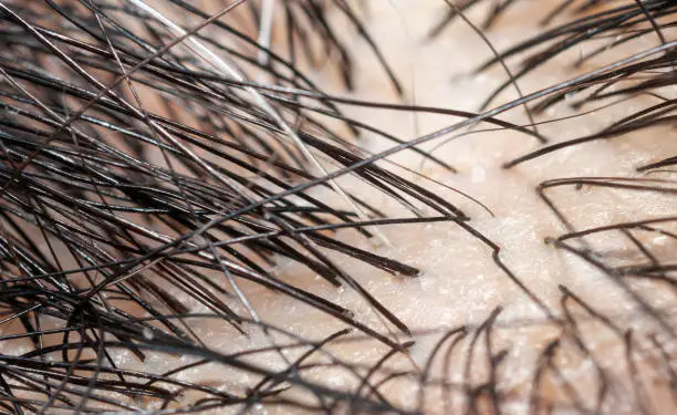 Photo of Macro photography of gray hair and black hair on Scalp.