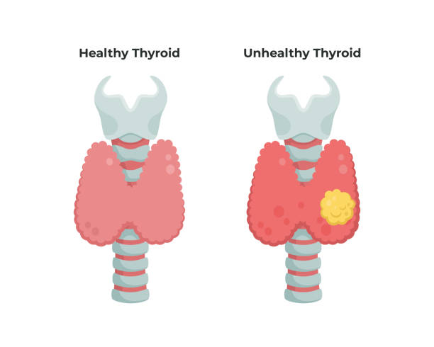 Healthy Thyroid gland and unhealthy thyroid with Inflammation and lump, thyroid cancer concept, flat illustration isolated on white background. Medical  infographic elements. Healthy Thyroid gland and unhealthy thyroid with Inflammation and lump, thyroid cancer concept, flat illustration isolated on white background. Medical  infographic elements thyroid disease stock illustrations