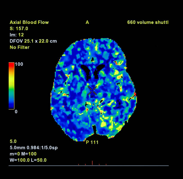perfuzja ct skanowania mózgu, czerwony i zielony i niebieski są obszary opóźnionego przepływu krwi do mózgu na perfuzji ct skanowania na ekranie. - mri scan cat scan machine x ray brain zdjęcia i obrazy z banku zdjęć