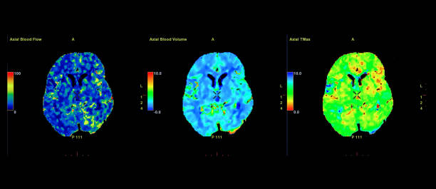 perfuzja ct skanowania mózgu, czerwony i zielony i niebieski są obszary opóźnionego przepływu krwi do mózgu na perfuzji ct skanowania na ekranie. - mri scan cat scan machine x ray brain zdjęcia i obrazy z banku zdjęć