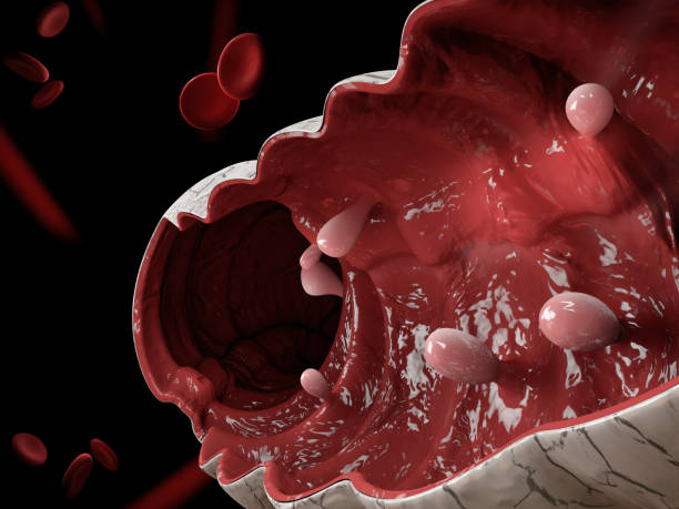 istock Colon polyps. 3d illustration, Polyp in the intestine. 1152336631