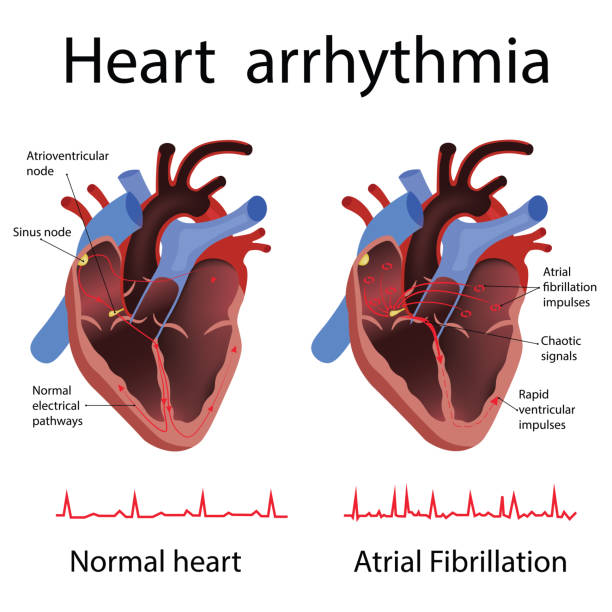 1 600 Arrhythmias Stock Illustrations Royalty Free Vector Graphics 1-600-arrhythmias-stock-illustrations-royalty-free-vector-graphics