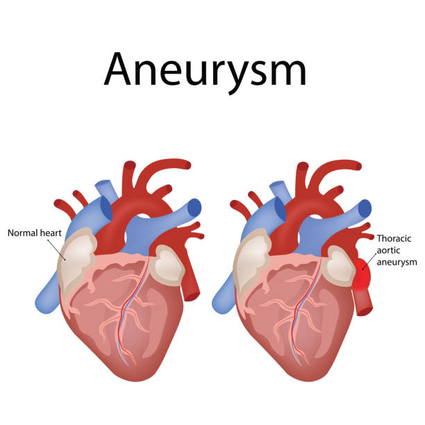 bildbanksillustrationer, clip art samt tecknat material och ikoner med hjärtats anatomi och typer av hjärt sjukdom vektor illustration - aorta