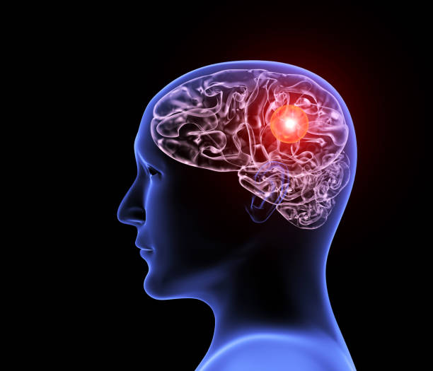 Human headache migraine Headache migraine. Human x-ray profile with brain, pain location highlighted in red. Isolated on black background. 3d render hematoma images stock pictures, royalty-free photos & images