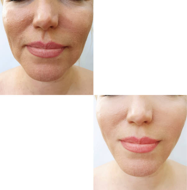 istock woman face wrinkles before and after correction 1152483023