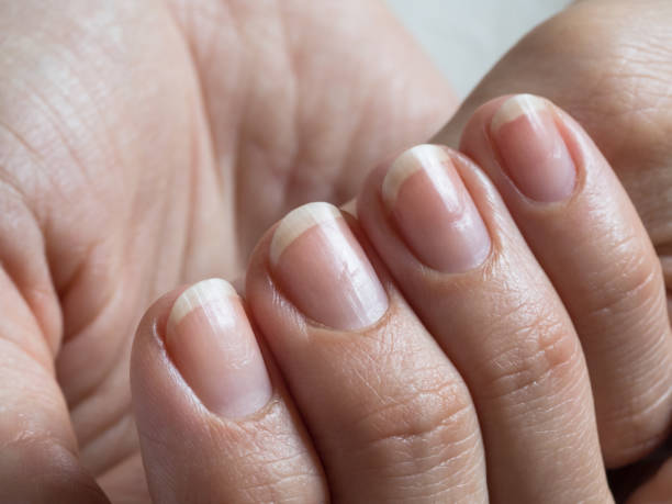 istock Damaged nails after gel polish. Close up. 1152484327