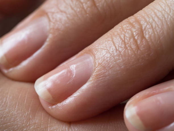 istock Damaged nails after gel polish. Close up. 1152484366