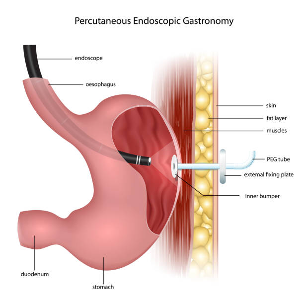 Percutaneous Endoscopic Gastronomy PEG application is the process of feeding a tube to the stomach by endoscopy in patients who cannot eat by mouth. feeding illustrations stock illustrations