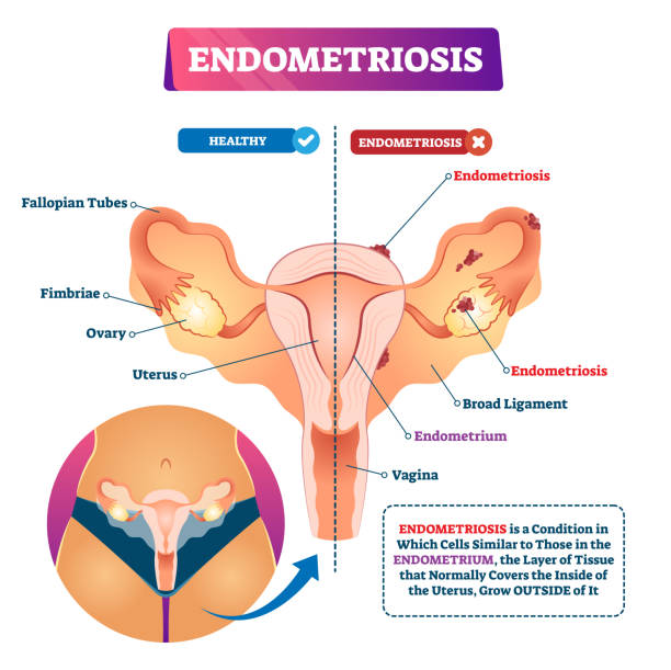 Endometriosis vector illustration. Labeled uterus gynecology illness scheme Endometriosis vector illustration. Labeled uterus gynecology illness scheme. Outside tissue growth condition inside female body. Compared vagina organ structure with painful sick and healthy example. Endometriosis stock illustrations