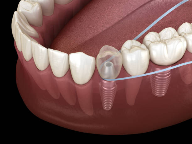 implant tooth cleaning with dental floss. medically accurate 3d illustration - implantat imagens e fotografias de stock