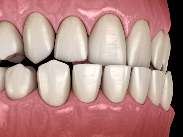 istock Underbite dental occlusion ( Malocclusion of teeth ). Medically accurate tooth 3D illustration 1152517501