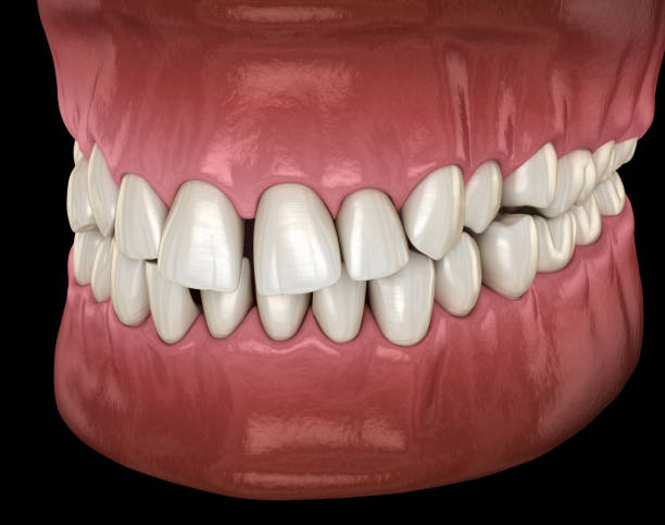 istock Healthy human teeth with normal occlusion, side view. Medically accurate tooth 3D illustration 1152517516