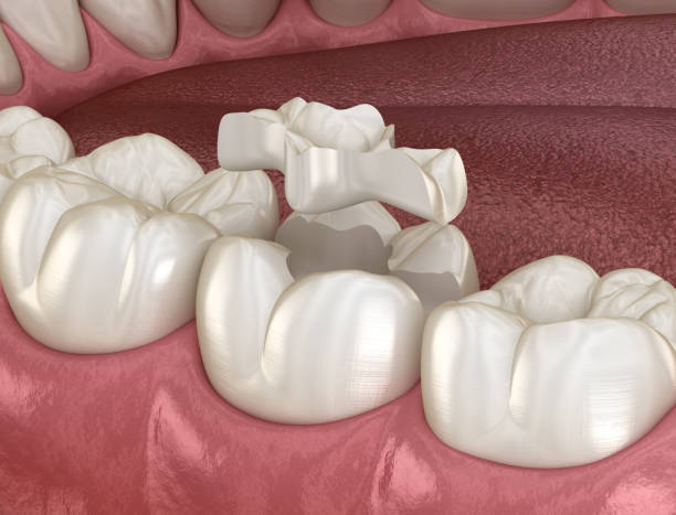 istock Inlay ceramic crown fixation over tooth. Medically accurate 3D illustration of human teeth treatment 1152517520