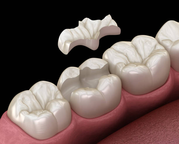 incrustation couronne céramique fixation sur la dent. illustration 3d médicalement exacte du traitement de dents humaines - inlaid photos et images de collection