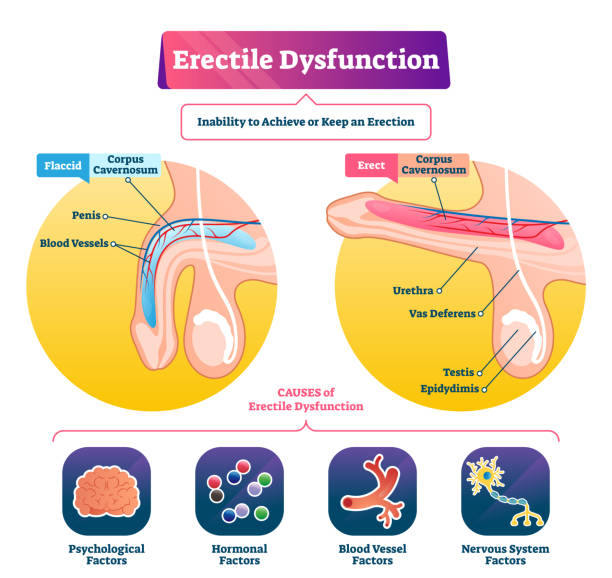 Erectile dysfunction vector illustration. Labeled impotence explain scheme. Erectile dysfunction vector illustration. Labeled impotence explain scheme. Medical illness with sexual male issues. Fertility potency problem and flaccid penis disorder. Corpus cavernosum lift state. male reproductive system diagram stock illustrations
