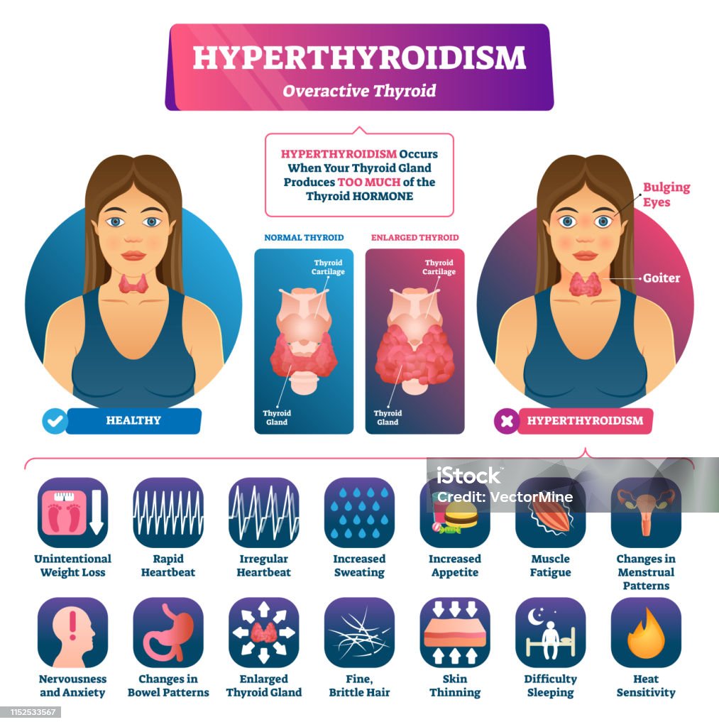 Hyperthyroidism Vector Illustration Labeled Medical Thyroid Gland hyperthyroidism-vector-illustration-labeled-medical-thyroid-gland