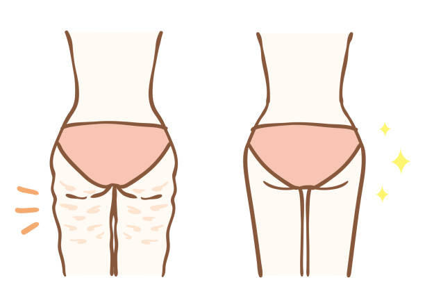 Before and after cellulite removal Before and after cellulite removal cellulite stock illustrations