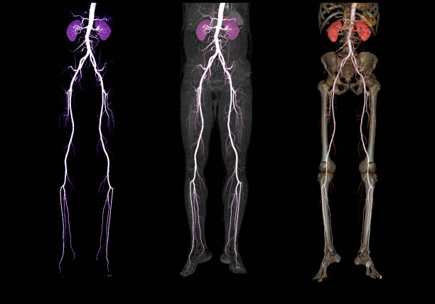 la comparación de la arteria femoral de cta ejecuta la imagen de renderizado 3d de la arteria femoral con riñón para los pacientes que presenten enfermedad arterial periférica aguda o crónica. - computed fotografías e imágenes de stock