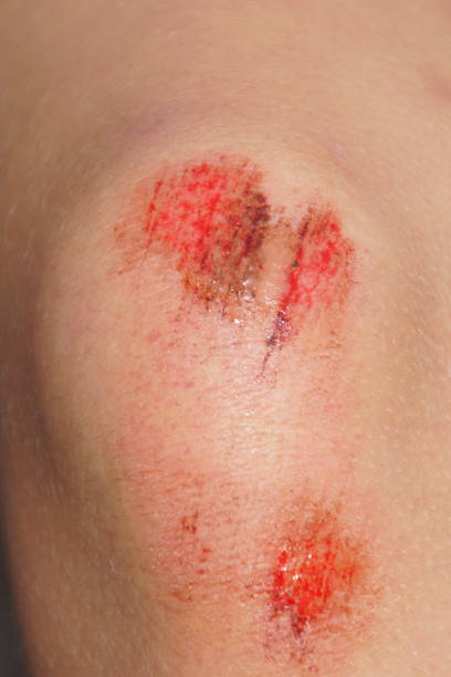 Wounded child knee. stock photo