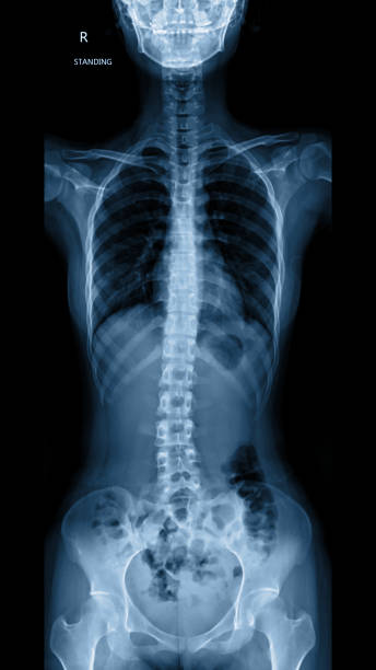 X-ray of whole spine in dark background. x-ray of whole spine showing straight spine of all parts cervical, thoracic and lumbar spine. x ray equipment stock pictures, royalty-free photos & images