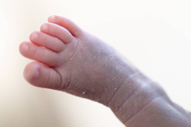 istock Palmoplantar psoriasis, allergic contact dermatits and atopic dermatitis in infants. 1153215169