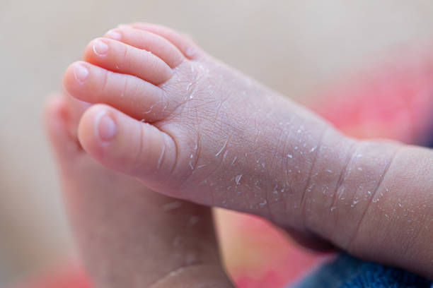 Palmoplantar psoriasis, allergic contact dermatits and atopic dermatitis in infants. stock photo
