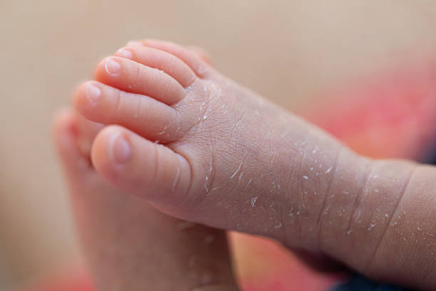 istock Palmoplantar psoriasis, allergic contact dermatits and atopic dermatitis in infants. 1153215200