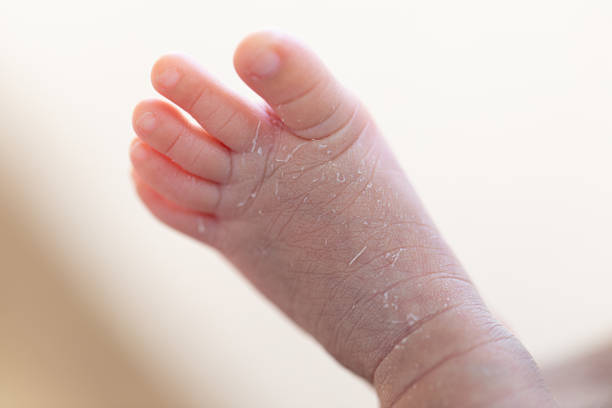 istock Palmoplantar psoriasis, allergic contact dermatits and atopic dermatitis in infants. 1153215229