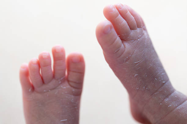 istock Palmoplantar psoriasis, allergic contact dermatits and atopic dermatitis in infants. 1153215231