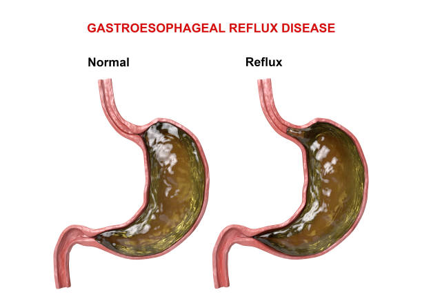 enfermedad por reflujo gastroesofágico-fallo del mecanismo digestivo (esfínter) que causa el paso del ácido gástrico al esófago - backwash fotografías e imágenes de stock