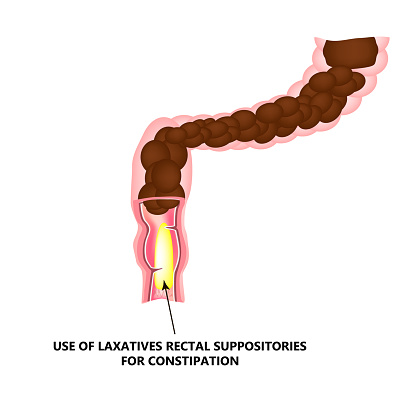 Use Of Laxatives Rectal Suppositories For Constipation Feces In Colon  Infographics Vector Illustration On Isolated Background Stock Illustration  - Download Image Now - iStock