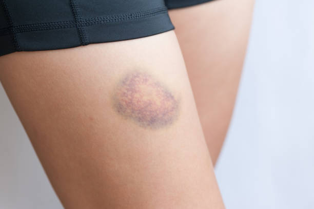 people with bruised leg closeup stock photo