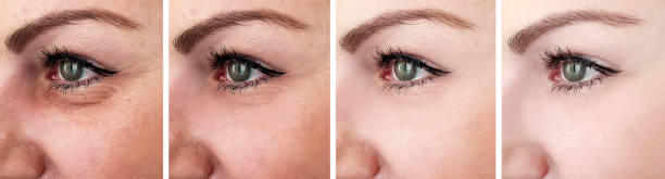 istock woman eyes wrinkles before and after collage 1153409486