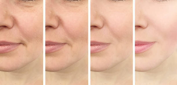 istock female face before and after treatment collage 1153461351