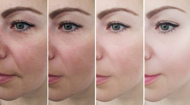 istock female face before and after treatment collage 1153466441