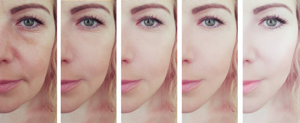 istock female face before and after treatment collage 1153468202