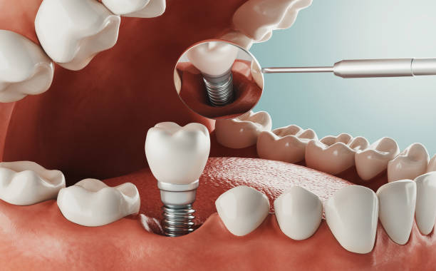 cure dentistiche, clinica moderna, rendering 3d - impianto dentale foto e immagini stock