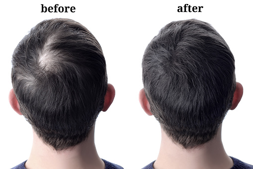 Men hair after using cosmetic powder for hair thickening. Before and after