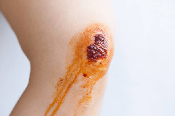 Scar and scab (eschar) on the knee Scar and scab (eschar) on the knee eschar stock pictures, royalty-free photos & images