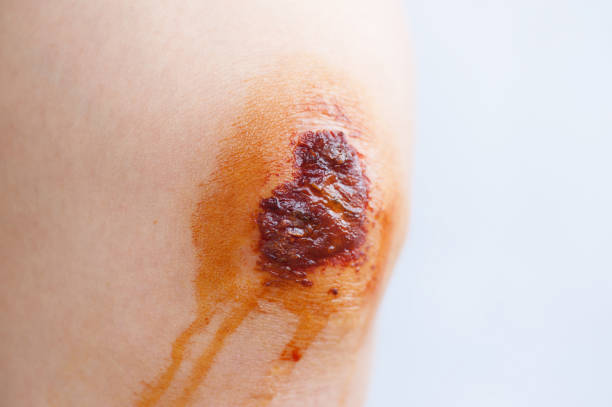 Scar and scab (eschar) on the knee Scar and scab (eschar) on the knee eschar stock pictures, royalty-free photos & images