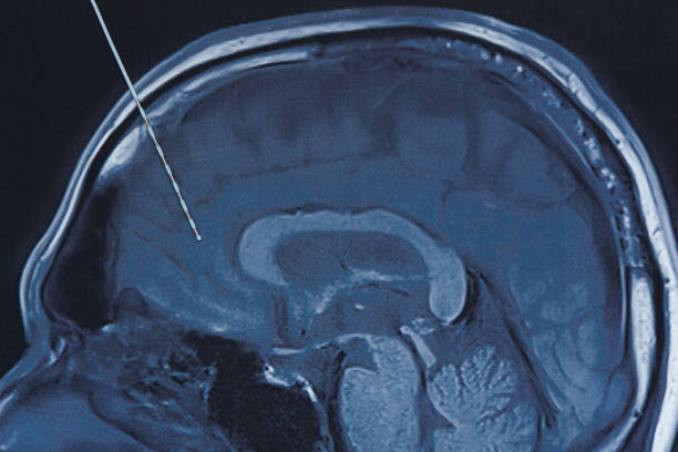 elettrodo di profondità sull'imaging della risonanza magnetica cerebrale. - eeg epilepsy science electrode foto e immagini stock
