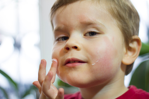 Two years old boy applying dermatological medicine on his face red from the allergy.